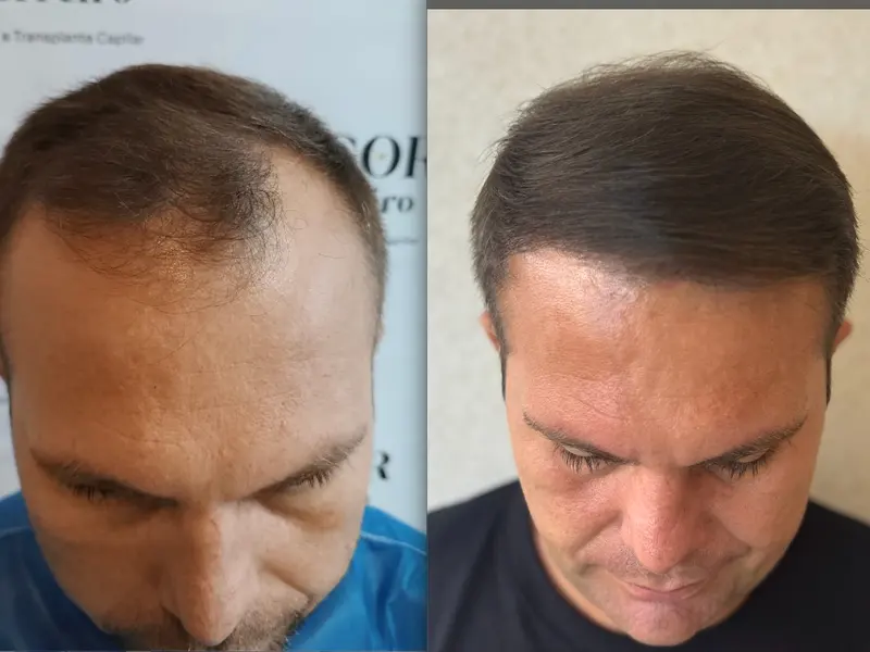 Antes e depois da linha frontal do cabelo em transplante capilar FUE, São Luís