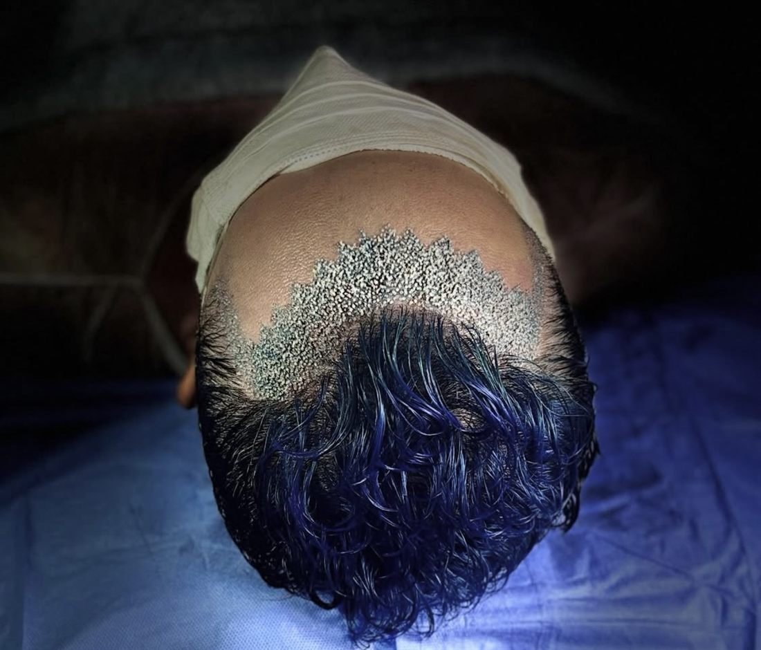 Transplante capilar FUE sendo realizado no Instituto Dr. Maxwell Pereira