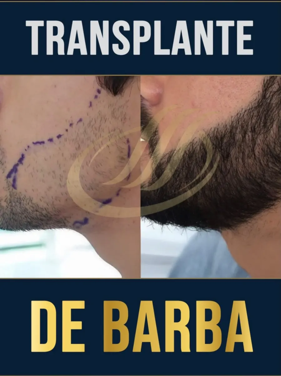 Resultado antes e depois de transplante de barba - caso 1