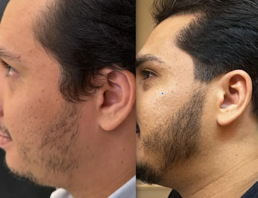 Resultado antes e depois de transplante de barba - caso 2