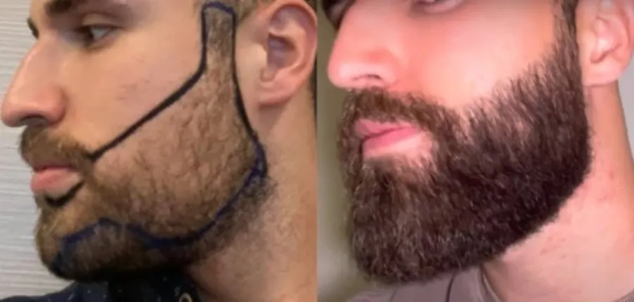 Resultado antes e depois de transplante de barba - caso 3