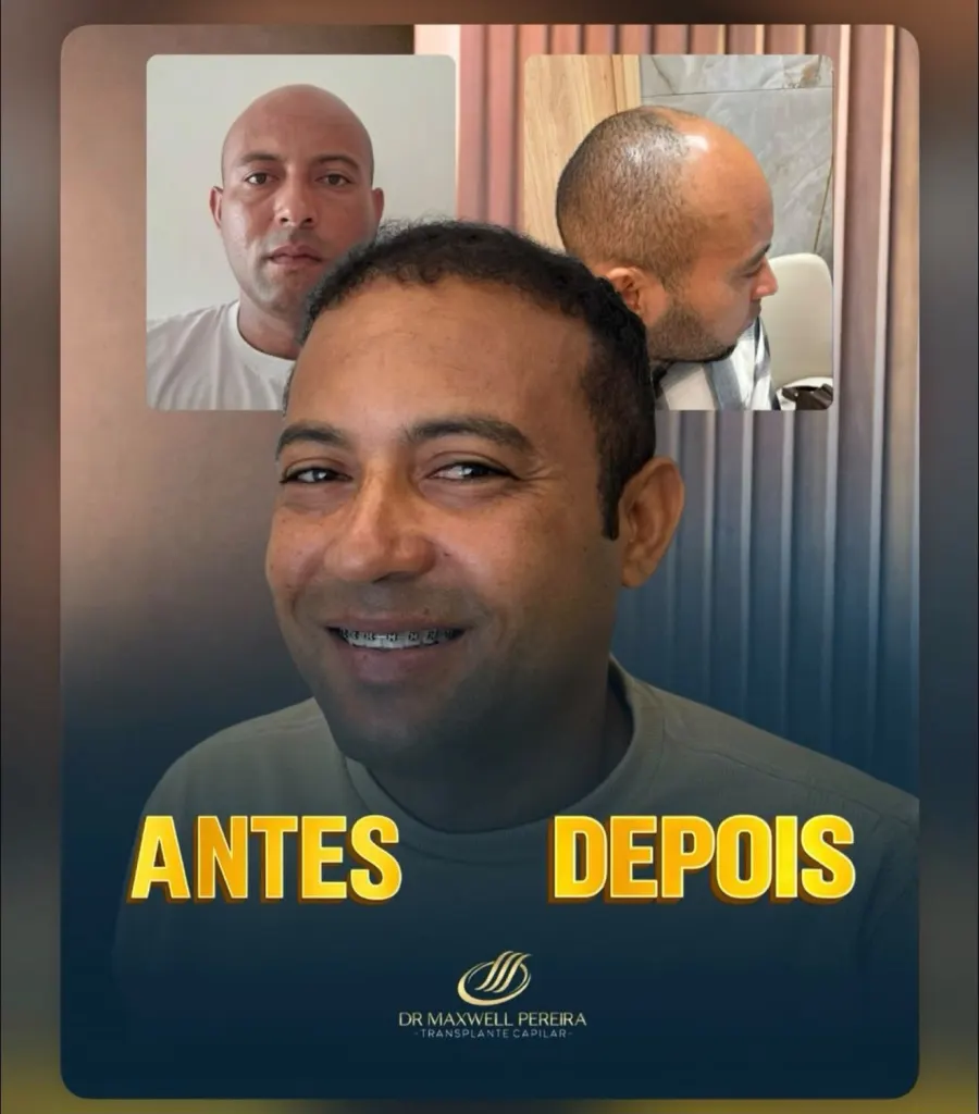 Resultado antes e depois de transplante capilar FUE - caso 1