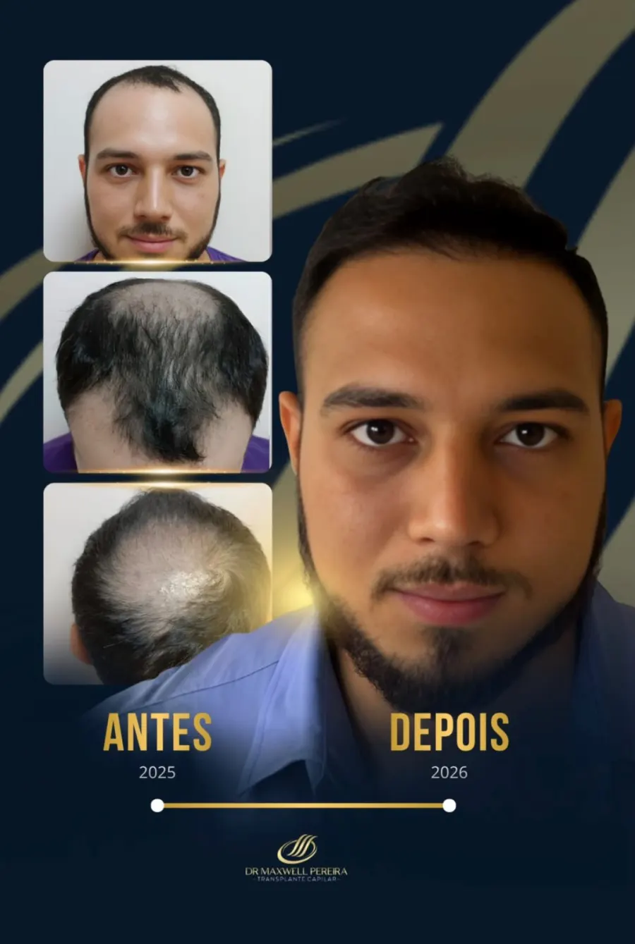Resultado antes e depois de transplante capilar FUE - caso 2