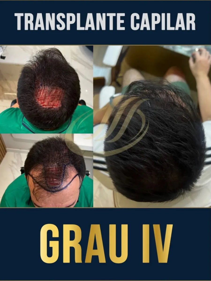 Resultado antes e depois de transplante capilar FUE, grau IV - caso 3