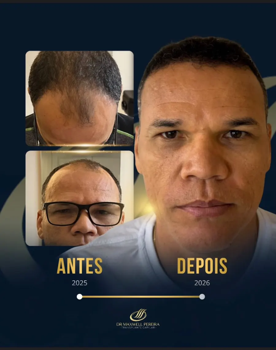 Resultado antes e depois de transplante capilar FUE - caso 4