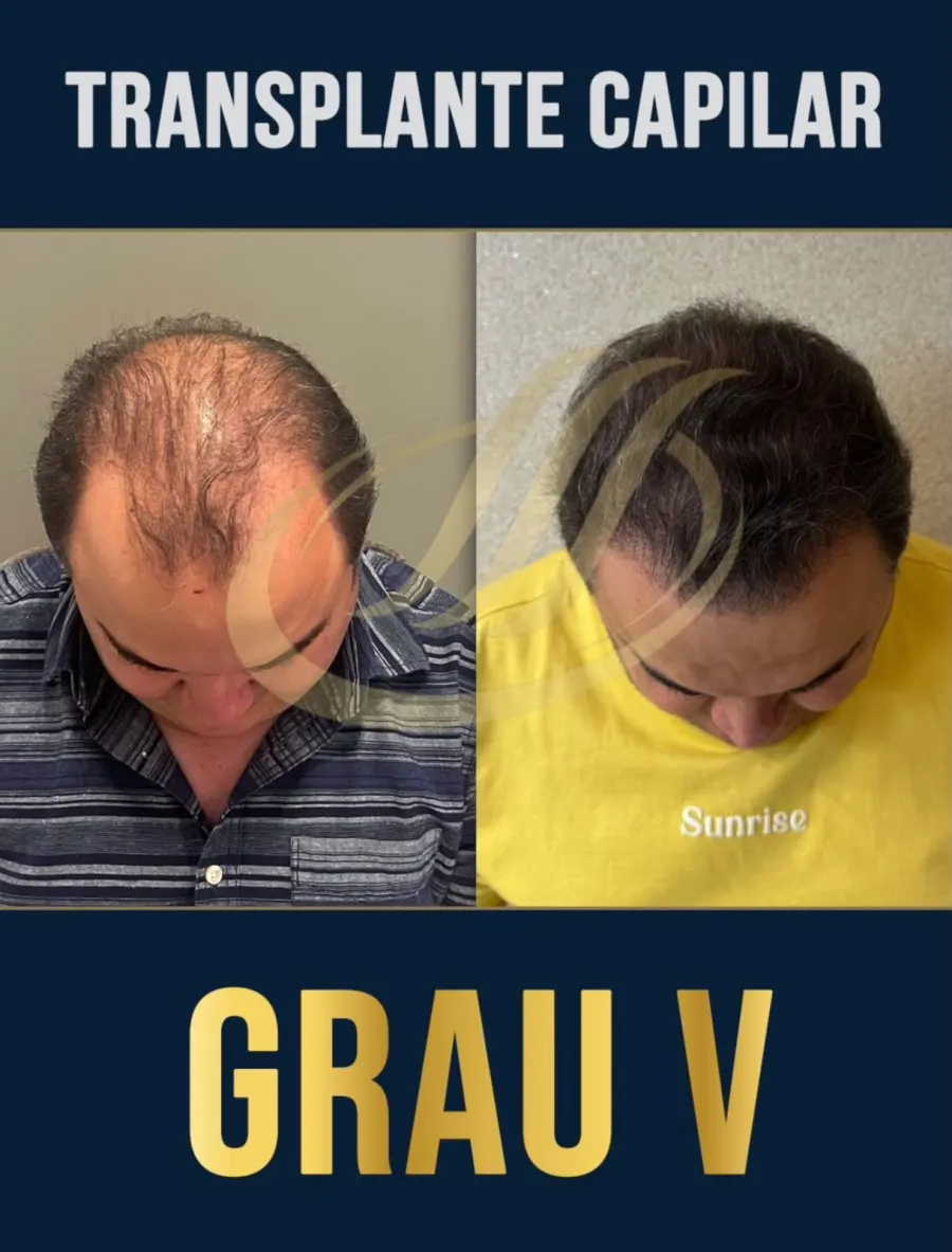 Resultado antes e depois de transplante capilar FUE, grau V - caso 5