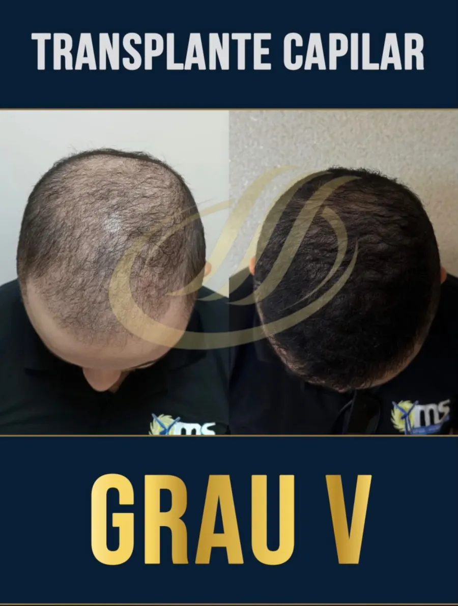 Resultado antes e depois de transplante capilar FUE, grau V - caso 6