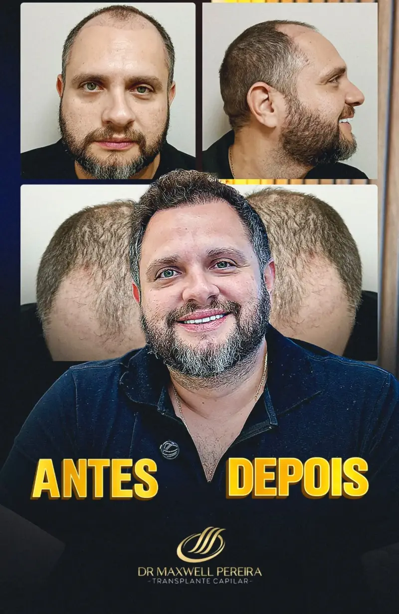 Resultado antes e depois de transplante capilar FUE - caso 7