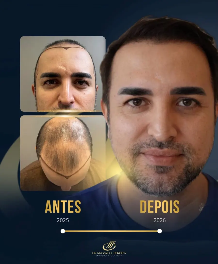 Resultado antes e depois de transplante capilar FUE - caso 8