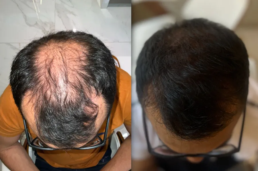Resultado antes e depois de transplante capilar FUE - caso 9