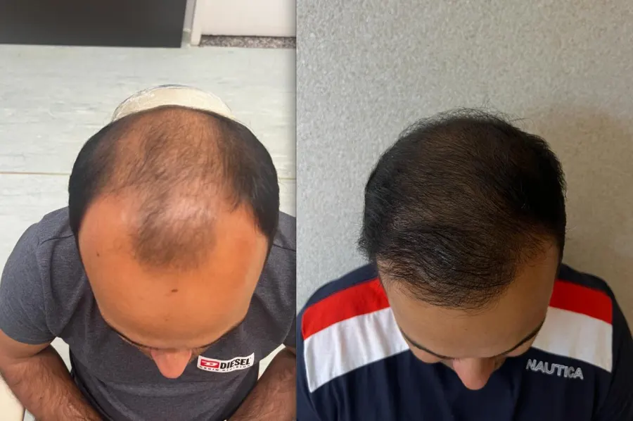 Resultado antes e depois de transplante capilar FUE - caso 10