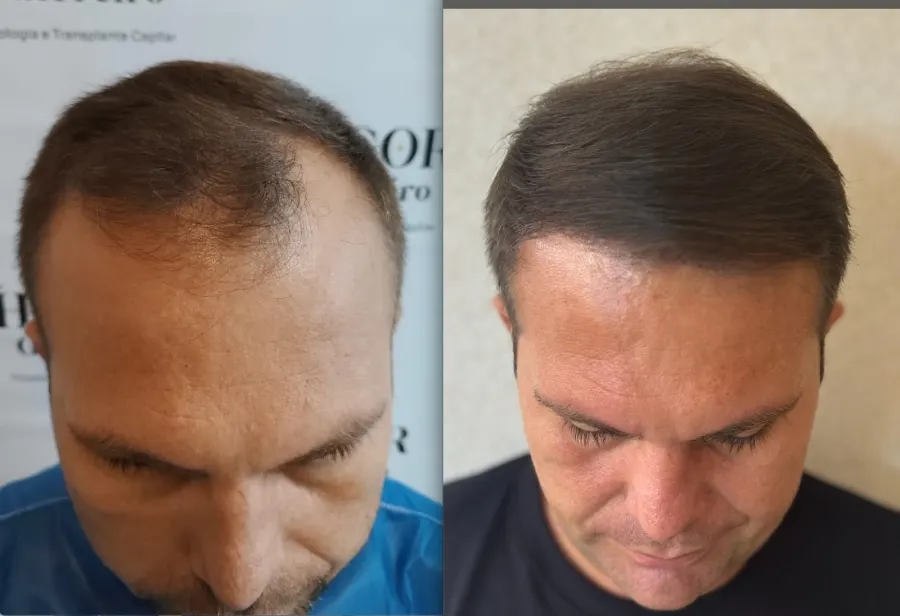 Resultado antes e depois de transplante capilar FUE - caso 11