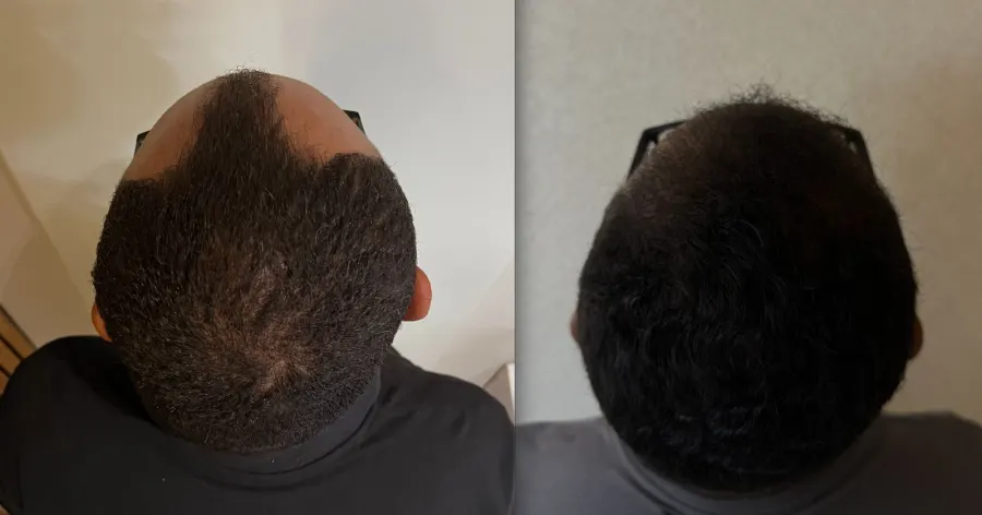 Resultado antes e depois de transplante capilar FUE - caso 12