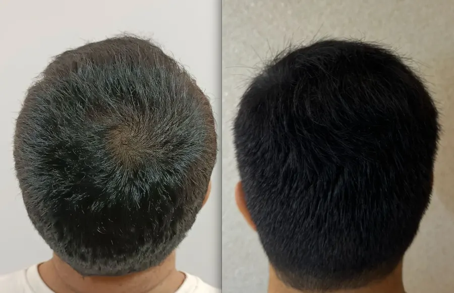 Resultado antes e depois de transplante capilar FUE - caso 13