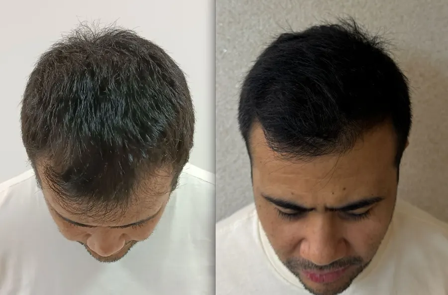 Resultado antes e depois de transplante capilar FUE - caso 14