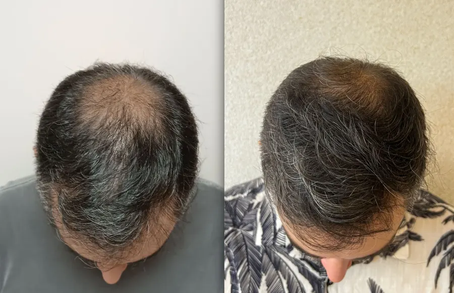 Resultado antes e depois de transplante capilar FUE - caso 15