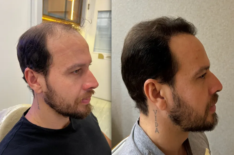 Resultado antes e depois de transplante capilar FUE - caso 16