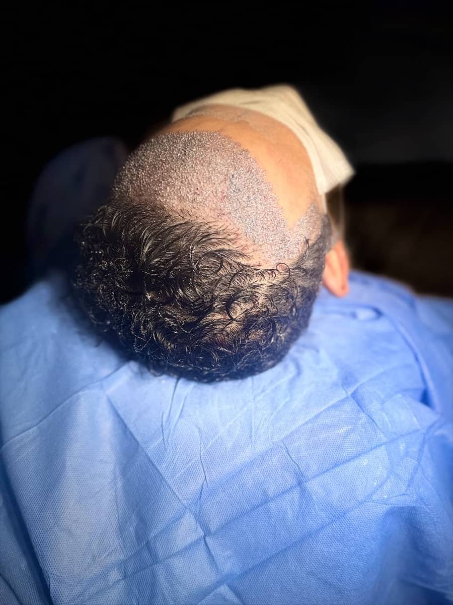 Área doadora do couro cabeludo após extração folicular FUE, sem cicatriz linear