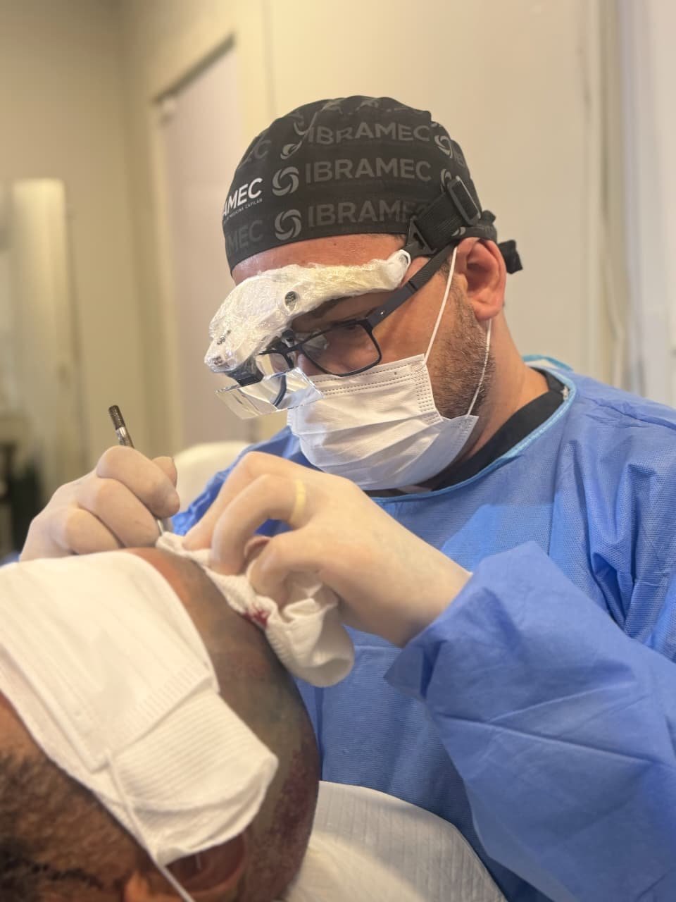 Detalhe da extração folicular individual na técnica FUE